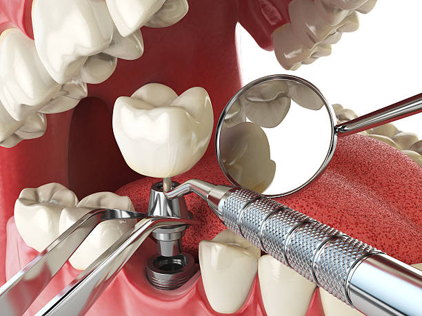 Best Emergency Tooth Extraction in Cherry Hill, VA